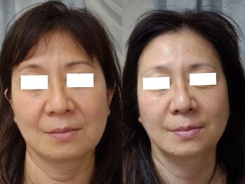 ティアス(t-us)/【覚醒】幹細胞フェイシャル