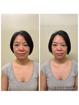 本八幡鍼灸院/美容はりのビフォーアフター