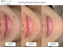 ヒーリングハーツ(Healing Hearts)/繰返すニキビ改善経過