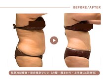 イエス マイサロン(yes My Salon)/脂肪冷却＋痩身施術症例