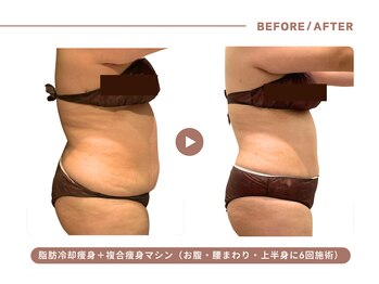 イエス マイサロン(yes My Salon)/脂肪冷却+痩身施術症例