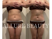 アリュールビューティー 下高井戸店(ALLURE BEAUTY)/60分4回コースモニター様