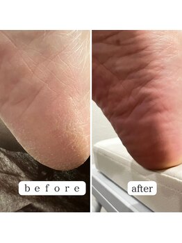 サロン カラフリー アシヤ(Salon Colorfulyy Ashiya)/フット贅沢角質ケアコース