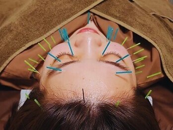 とだ鍼灸指圧治療院の写真/【しっかり刺激で即効性◎本気の美容鍼】お顔のコリを徹底的に解消。骨を削らなくても自分史上最高の小顔へ