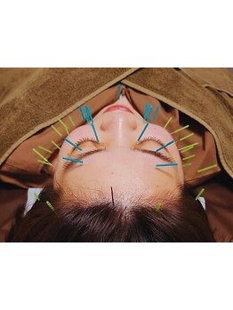 鍼灸施術を受けたい