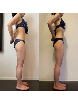 レナトゥス 銀座(Renatus)/BeforeAfter【痩身/東京/銀座】