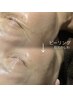 【ピーリング】目下・目尻・眉間のシワ・シミケア