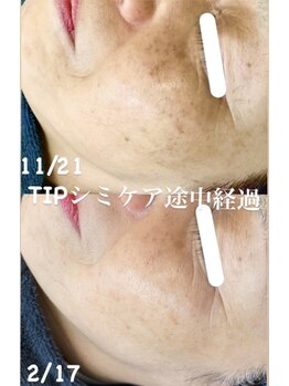 ミエル(miel)/【シミケア×ハーブピーリング】