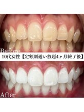 ホワイト 福岡天神店(WHITE)/ホワイトニングビフォーアフター