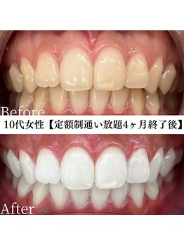 ホワイト 福岡天神店(WHITE)/ホワイトニングビフォーアフター