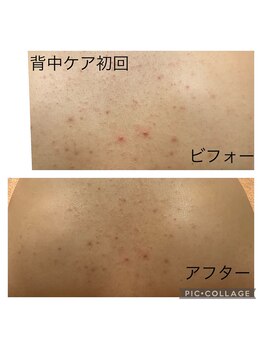 パルティノ 高崎店/【症例】背中ケア☆