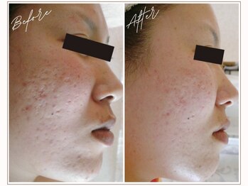 ミューベル(MYubelle)/毛穴ケア 水光ピーリング