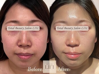 エル 麻布十番/たるみ/小顔/毛穴/フェイシャル