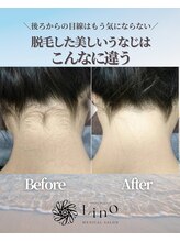 リノ沼津(Lino)/うなじ脱毛