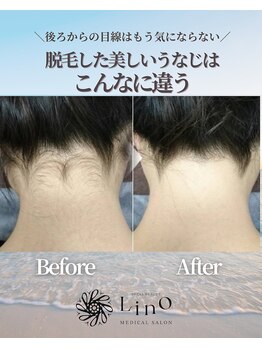 リノ沼津(Lino)/うなじ脱毛