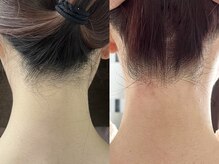 シロ(Shiro)/うなじのデザイン脱毛