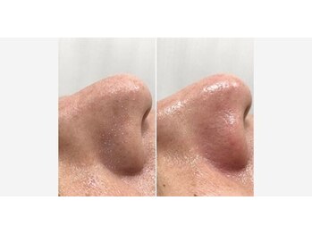 イエナ(IENA)/毛穴は定期的にお掃除しましょう