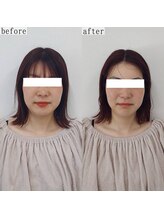 ヴェルシック(Belchic)/密かに人気の脂肪分解