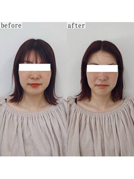 ヴェルシック(Belchic)/密かに人気の脂肪分解