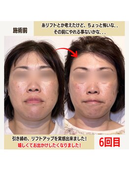 経堂鍼灸整体院/幹細胞美容鍼+小顔矯正