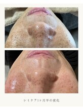 白の雫/頬の細かいシミ｜1ヶ月半の変化