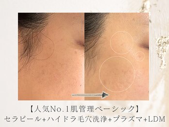 アネラボーテ(Anela Beaute)/人気No.1肌管理ベーシック 2回目