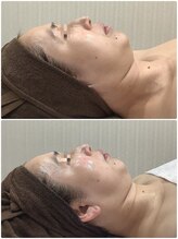 エスアール アミティ(SR Amity)/インディバ横顔リフト