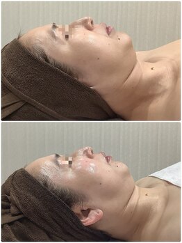 エスアール アミティ(SR Amity)/インディバ横顔リフト