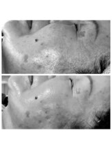 ディープブルー(Deep Blue)/プラペンデュアル×臍帯