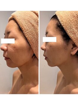 エムフルール 吹田市/小顔detoxフェイシャル