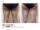 脱毛サロン　ｓｉｍｐｌｅ＋【6月NEW OPEN（予定）】の写真