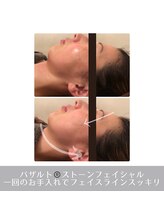 ラ ルミエール(La Lumiere)/顎周り/フェイスラインスッキリ2