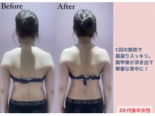 じぶんdeエステ 梅田店/CELLZERO.式　症例/肩・背中/1回