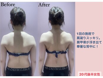 じぶんdeエステ 梅田店/CELLZERO.式 症例/肩・背中/1回