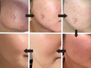 ニュウ(Nyu)/ハーブピーリング