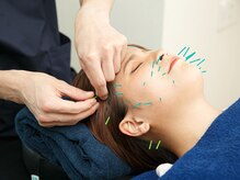 ハリハリ(HALIHALI)/お顔の鍼施術☆