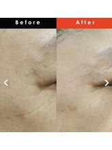 アリアンド(ari.and)/ララピール　症例写真