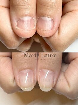 マリーロール 淀屋橋本店(Marie Laure)/自爪育成/深爪矯正/ネイルケア