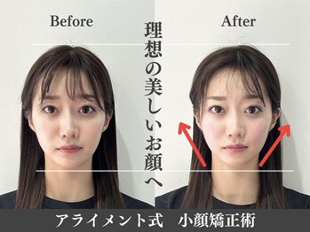 アライメント 自由が丘(Alignment)/フェイスライン改善♪