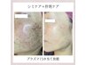 人気No1★シミ改善！プラズマシミケア15分　12,000円→7,700円