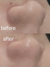 チル(chill)/毛穴洗浄