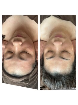 絢香/フェイシャル1回