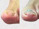 【フットケア】巻き爪矯正