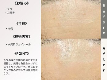 ルディラ 上野店/水光肌フェイシャル