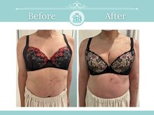 美人バスト 新宿店/☆バストアップ症例写真☆