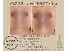 不動の人気menu★毛穴のお悩み、肌荒れ予防にはこれ！！毛穴洗浄★ハイドロスプラッシュ＋高保湿パック付