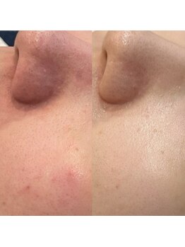 パリスヒロトン(PARIS HIROTON)/オプティル×ハーブピーリング