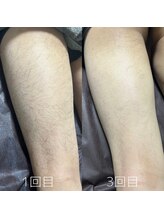 カナウ(KANAU)/足脱毛（20代前半男性）