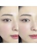 【産毛ゼロ★肌ツヤ】フルフェイスWAX脱毛+HBL(ハリウッドブロウリフト)