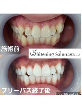 ホワイトニングサロン 京都烏丸店/ホワイトニング施術例